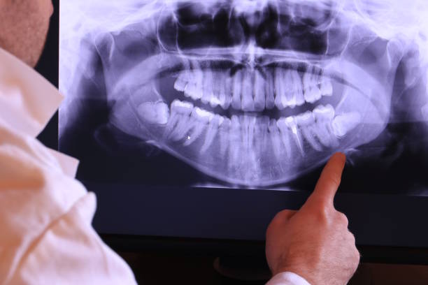 Best Emergency Wisdom Teeth Removal in Sage, CA
