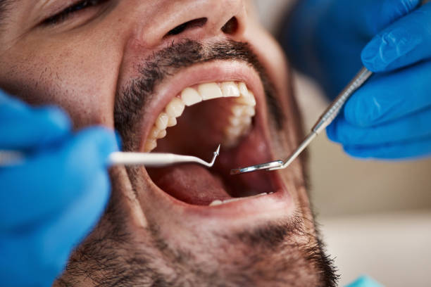 Best Emergency Tooth Extraction in Sage, CA